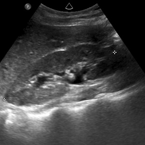 Abdominale et rénale