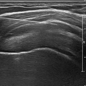 Infiltration sous échographie, radiographie ou scanner