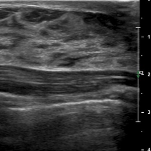 Mammographie femme enceinte
