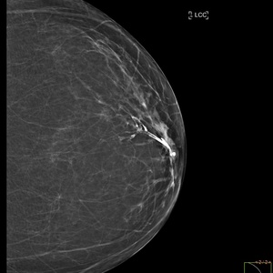 Galactographie