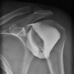 Capsulodistension