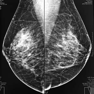 Mammographie numérisée