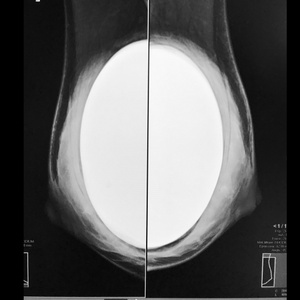 Mammographie et prothèse mammaire