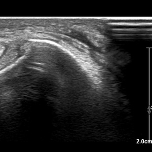 Musculaire et tendineuse