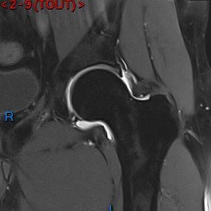 Arthro IRM